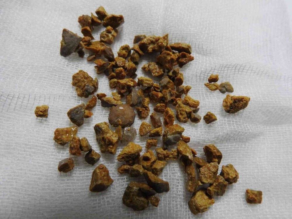 (Özel) Böbreğindeki taş 100 parçaya ayrılarak çıkarıldı