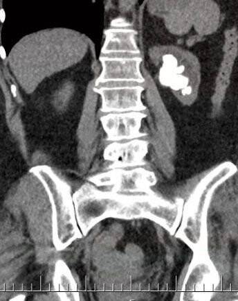 (Özel) Böbreğindeki taş 100 parçaya ayrılarak çıkarıldı