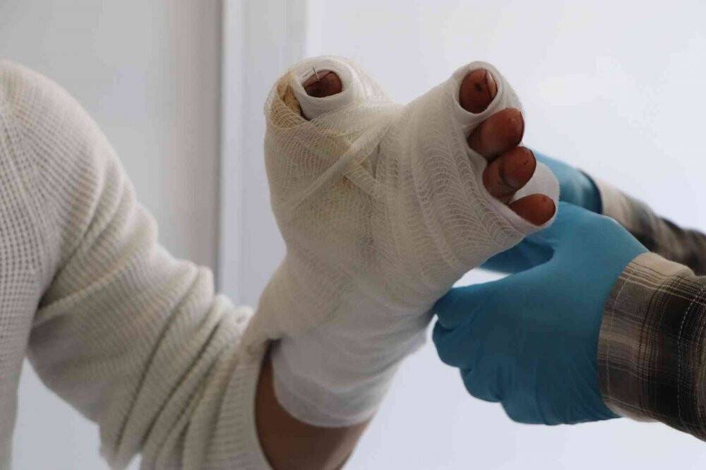 Kopan başparmağı 8 saat sonra yerine dikildi