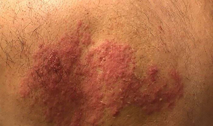 Zayıflayan bağışıklık zona vakalarını artırdı