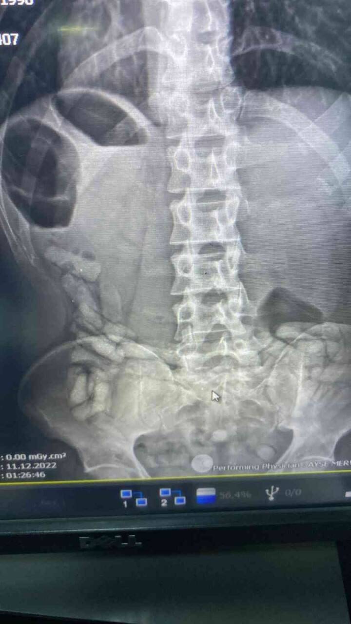 İranlı şahsın midesinden 55 kapsül afyon sakızı çıktı