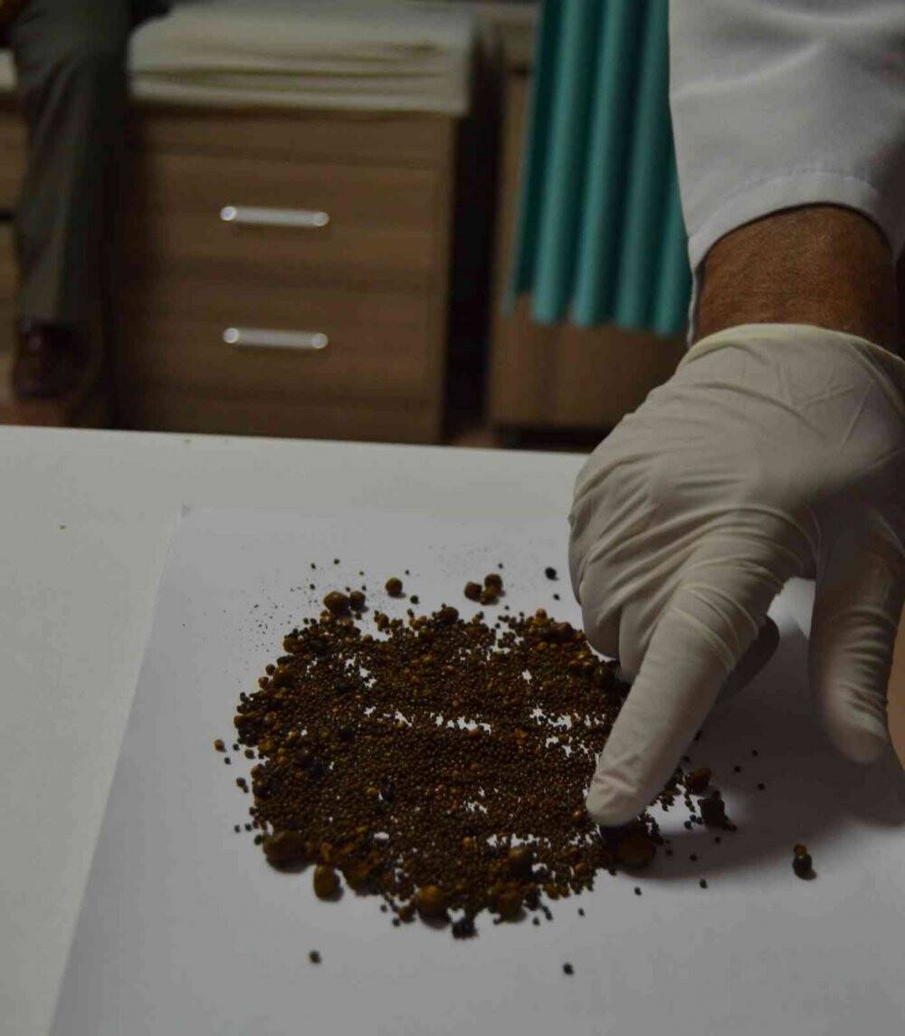 Safra kesesi değil sanki taş ocağı