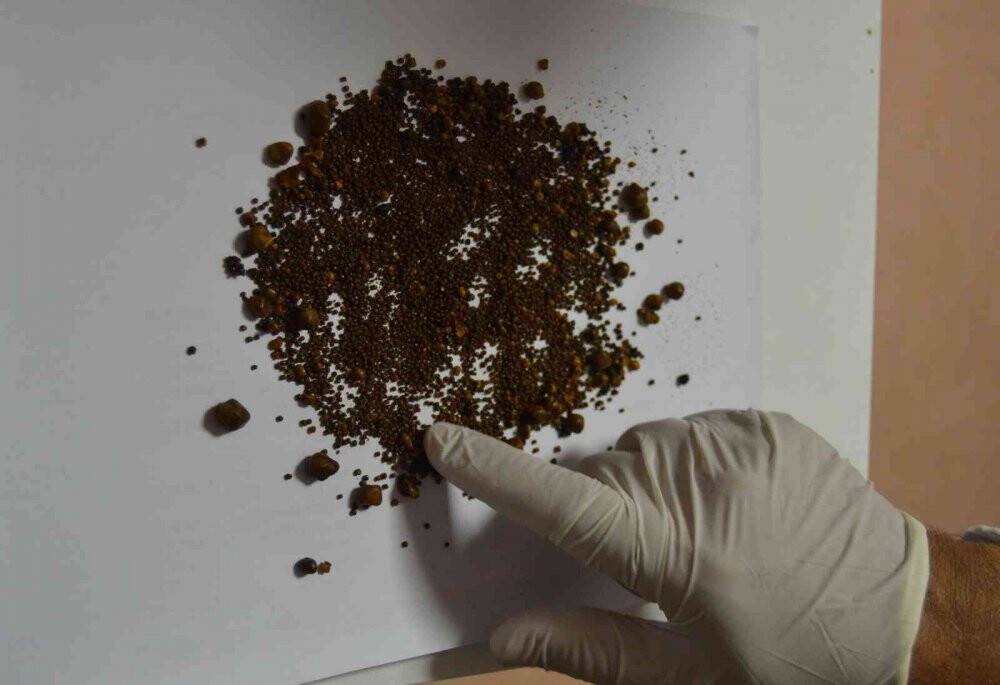 Safra kesesi değil sanki taş ocağı