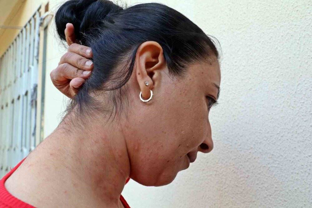 Bahçesindeki tırtılları süpürdü, hastanelik oldu