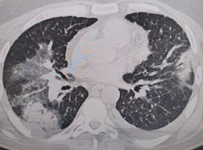 Klimaya bağlı “yaz zatürresine” dikkat