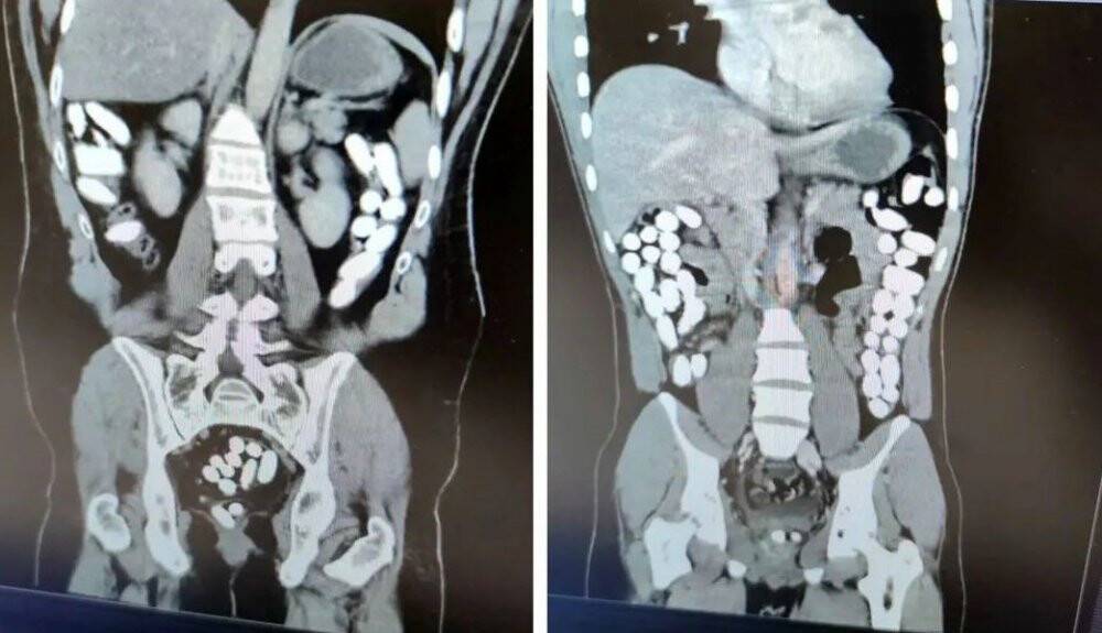 Midelerinden 2 kilo uyuşturucu çıktı