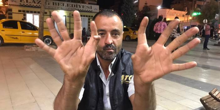 Elazığ’da 11 parmaklı adam görenleri hayrete düşürüyor
